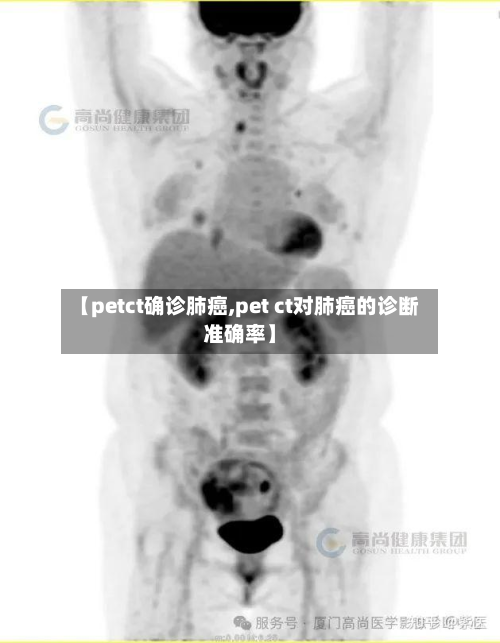 【petct确诊肺癌,pet ct对肺癌的诊断准确率】-第1张图片
